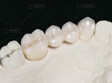 tensile strength zirconia|fmz crown.